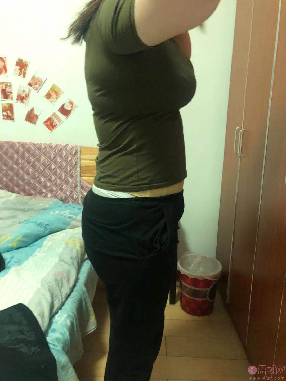 厦门新开元医疗美容腰腹吸脂怎么样？附吸脂案例真人分享及2020价格表一览