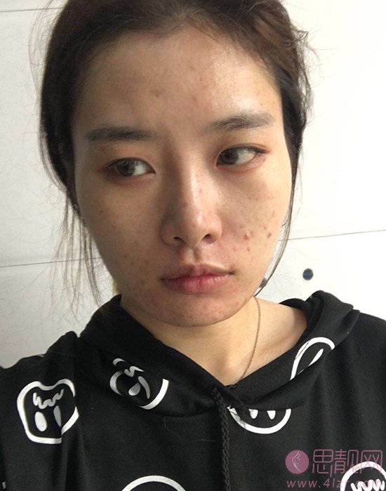 南京军区福州总医院激光整形美容中心祛痘如何？附祛痘前后真人案例分享