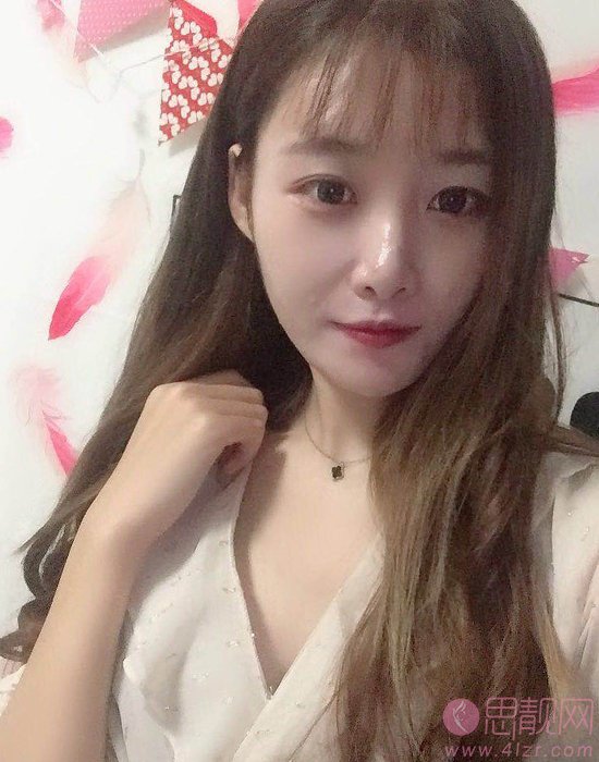 南京军区福州总医院激光整形美容中心祛痘如何？附祛痘前后真人案例分享