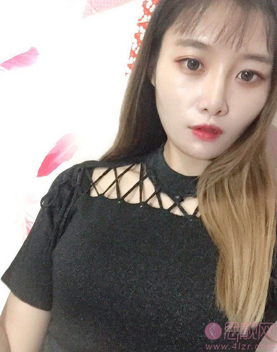 南京军区福州总医院激光整形美容中心祛痘如何？附祛痘前后真人案例分享