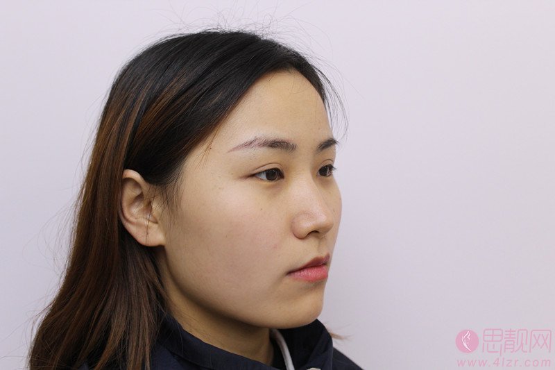 福州中意整形美容面部吸脂怎么样？2020价格表一览+吸脂瘦脸案例分享