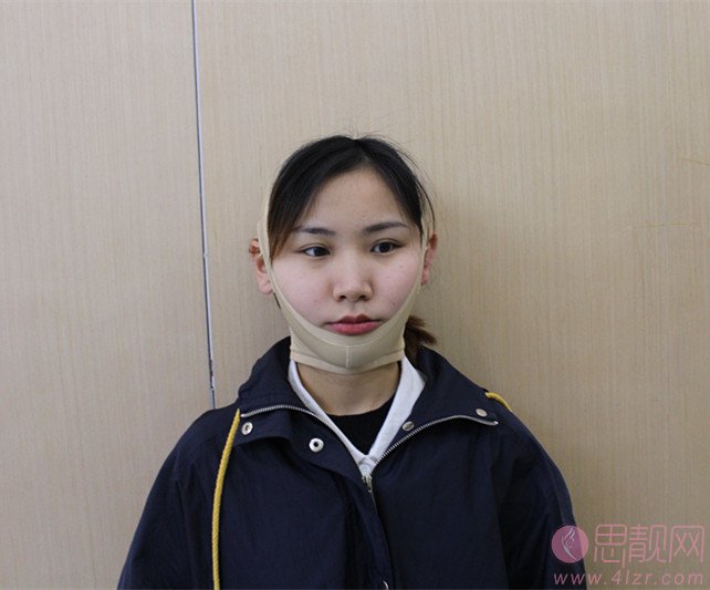 福州中意整形美容面部吸脂怎么样？2020价格表一览+吸脂瘦脸案例分享