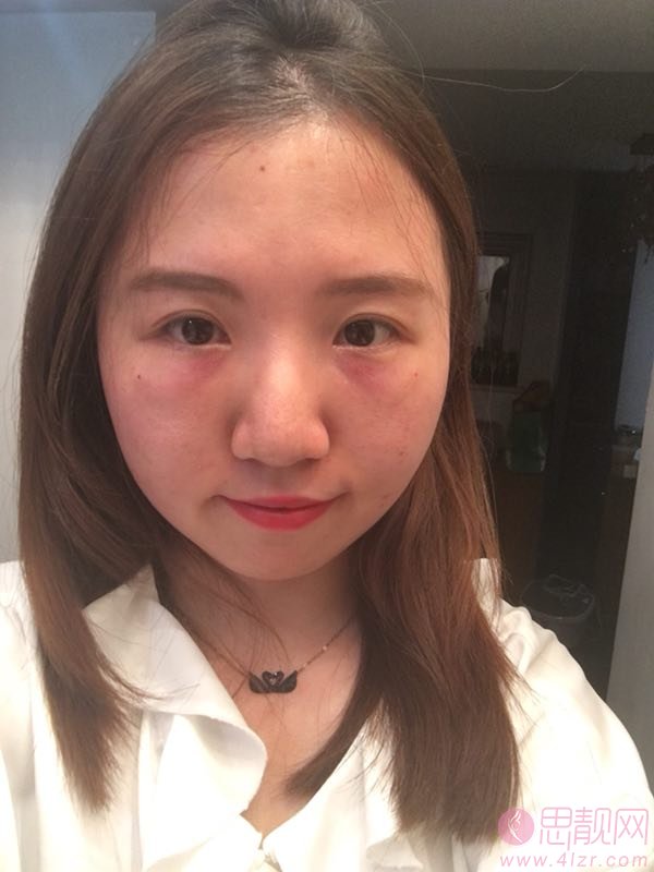 成都僮颜医疗美容祛眼袋怎么样？祛眼袋前后对比效果及2020价格表曝光