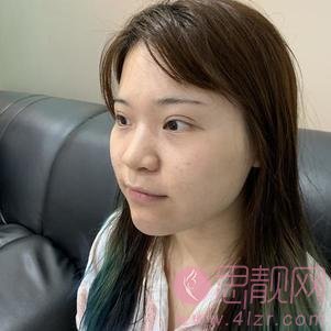 成都素美医疗美容卢元刚隆鼻怎么样？附隆鼻真人案例及2020价格表一览