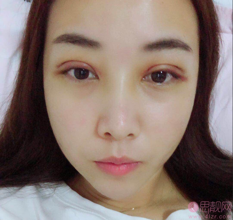 上海纽菲思整形美容（徐汇总院）刘洋做双眼皮怎么样？2020价格表曝光+双眼皮真人案例分享