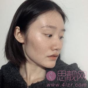 上海诺诗雅医疗美容医院隆鼻好不好？附隆鼻真人分享及2020价格表一览