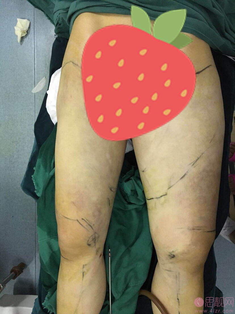 上海茸城医疗美容吸脂瘦大腿多少钱？2020价格表一览+吸脂瘦大腿真人案例分享