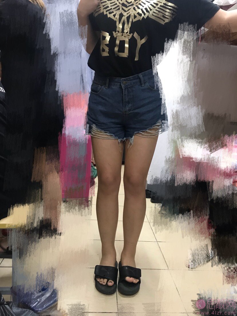 上海茸城医疗美容吸脂瘦大腿多少钱？2020价格表一览+吸脂瘦大腿真人案例分享