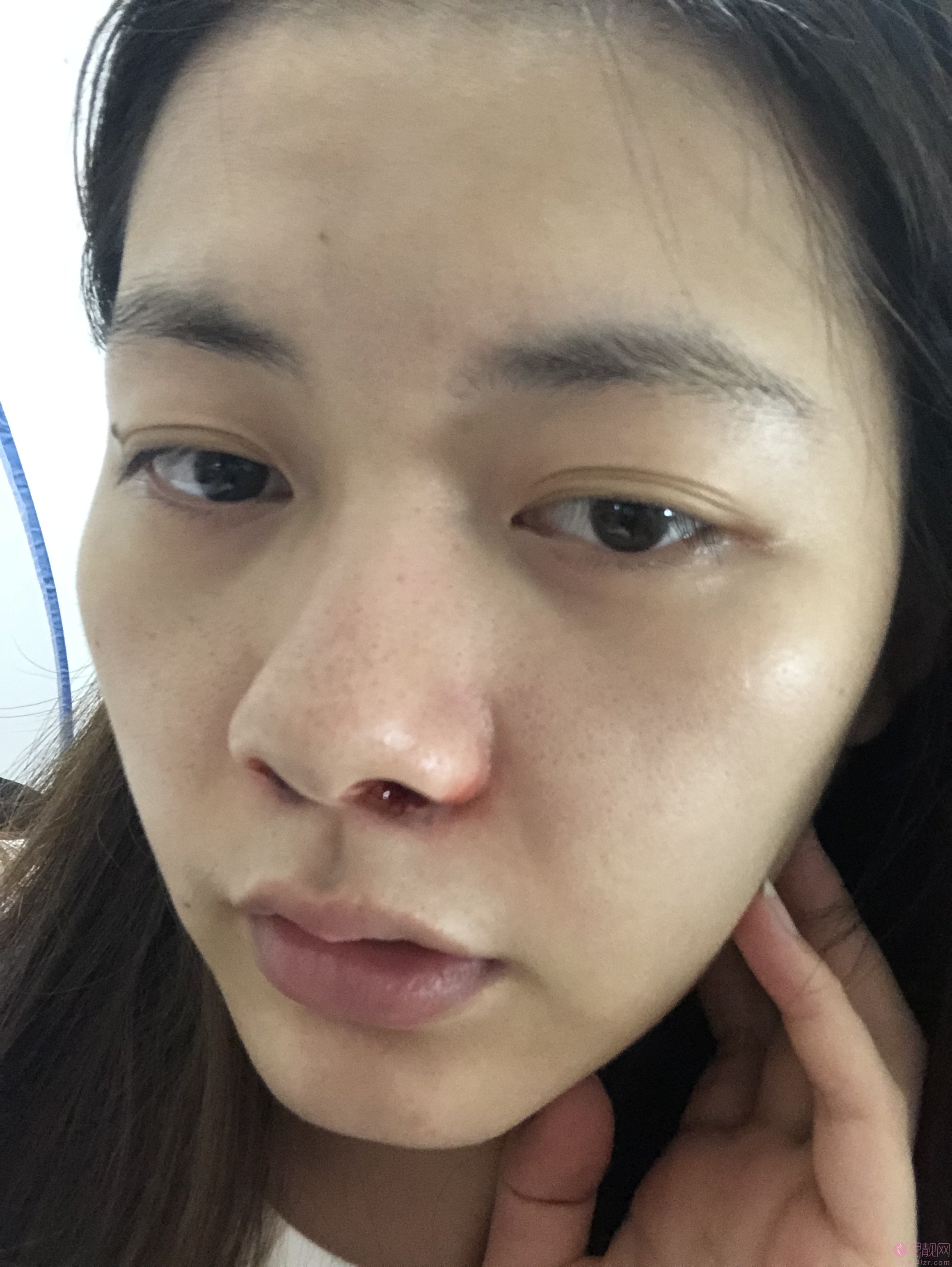 上海瑞瑷医疗美容宋东明隆鼻如何？附隆鼻真人分享及2020价格表曝光