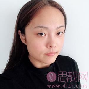上海同济大学附属天佑医院医疗美容科切开双眼皮多少钱？2020价格表一览+双眼皮真人案例分享