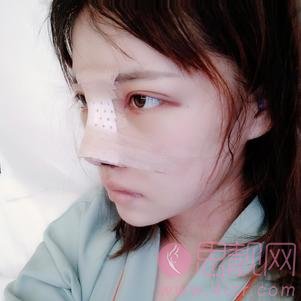 上海薇琳医疗美容医院曹芳隆鼻怎么样？2020价格表曝光+隆鼻真人案例分享