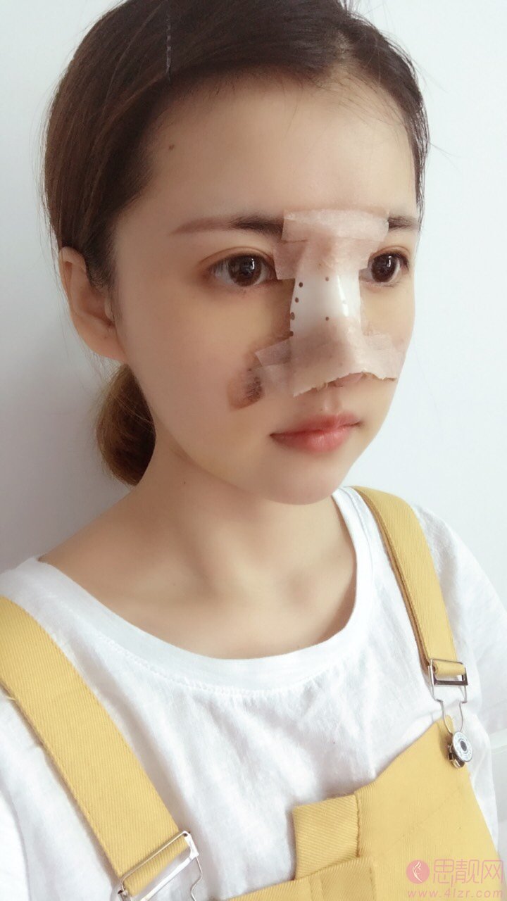 上海薇琳医疗美容医院曹芳隆鼻怎么样？2020价格表曝光+隆鼻真人案例分享