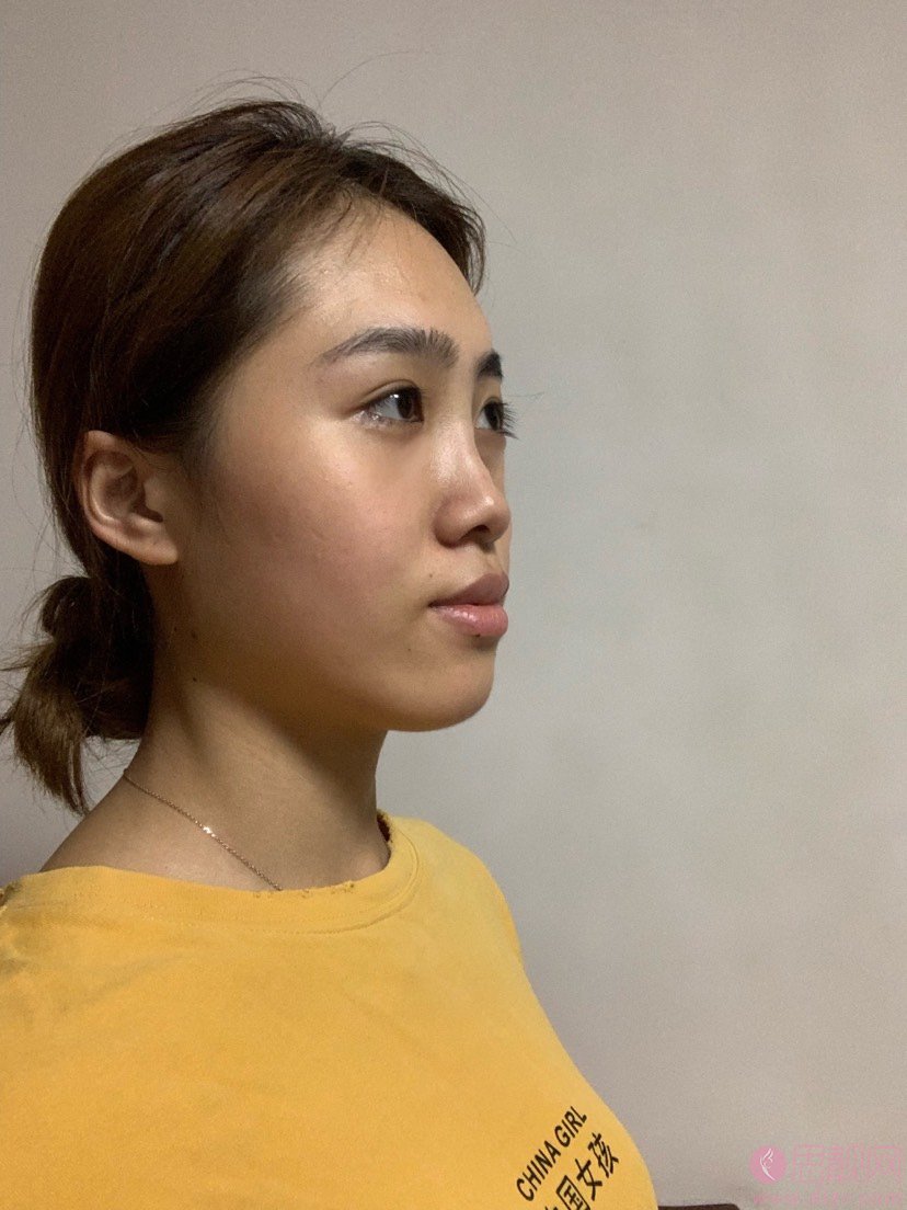 上海漾颜医疗美容杨济泽隆鼻好不好？附隆鼻真人分享及2020价格表一览