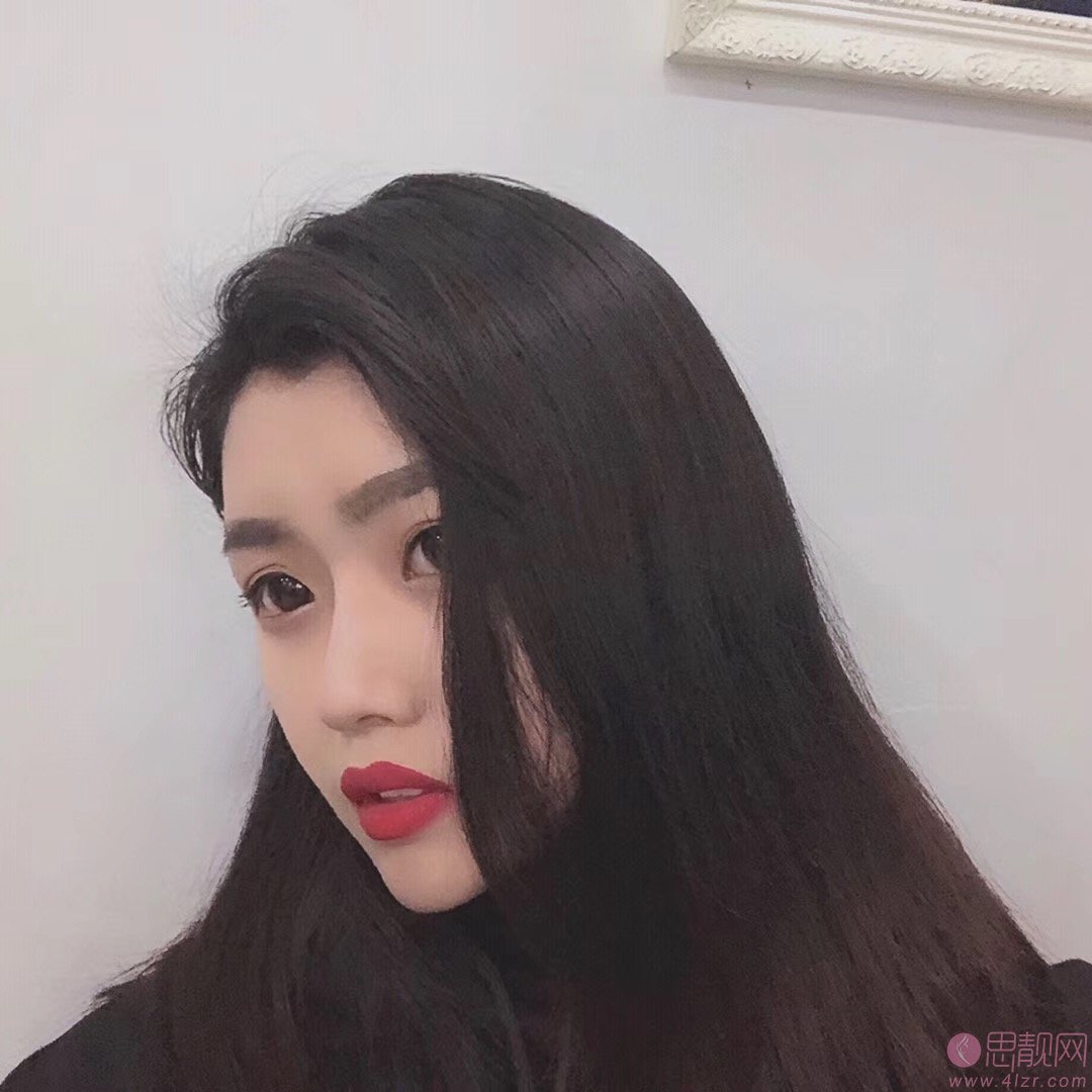 上海伊莱美医疗美容医院邱文苑隆鼻怎么样？2020价格表曝光+隆鼻真人案例分享