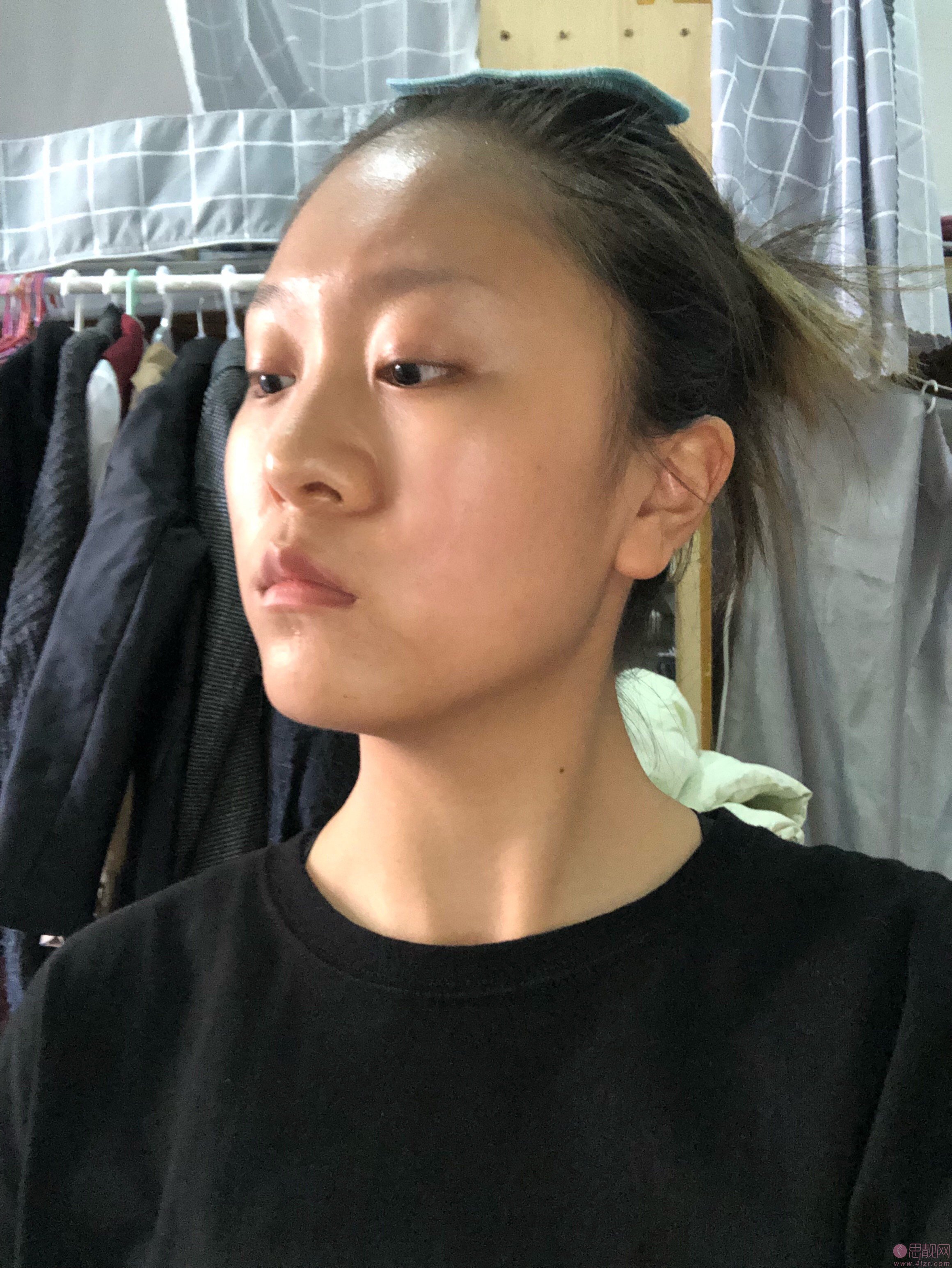 上海银城医疗美容医院隆鼻怎么样?附隆鼻真人案例分享