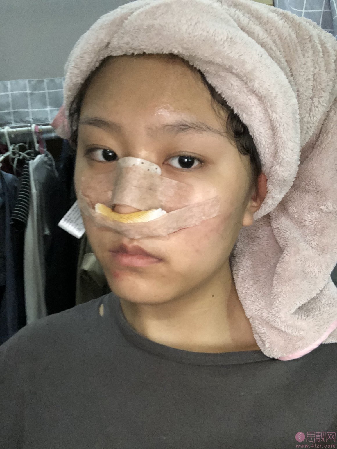 上海银城医疗美容医院隆鼻怎么样?附隆鼻真人案例分享