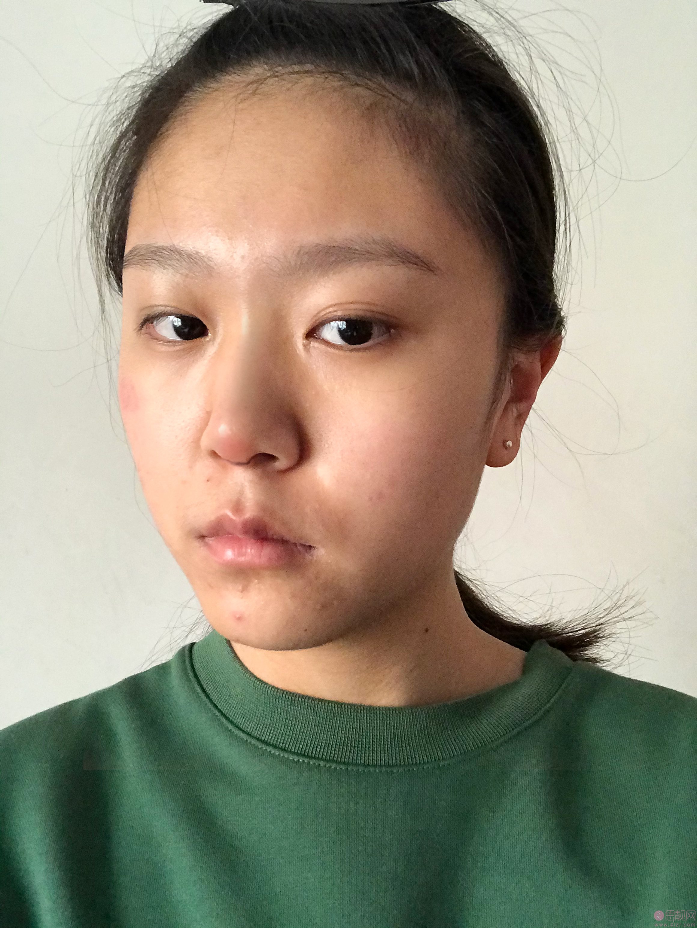上海银城医疗美容医院隆鼻怎么样?附隆鼻真人案例分享