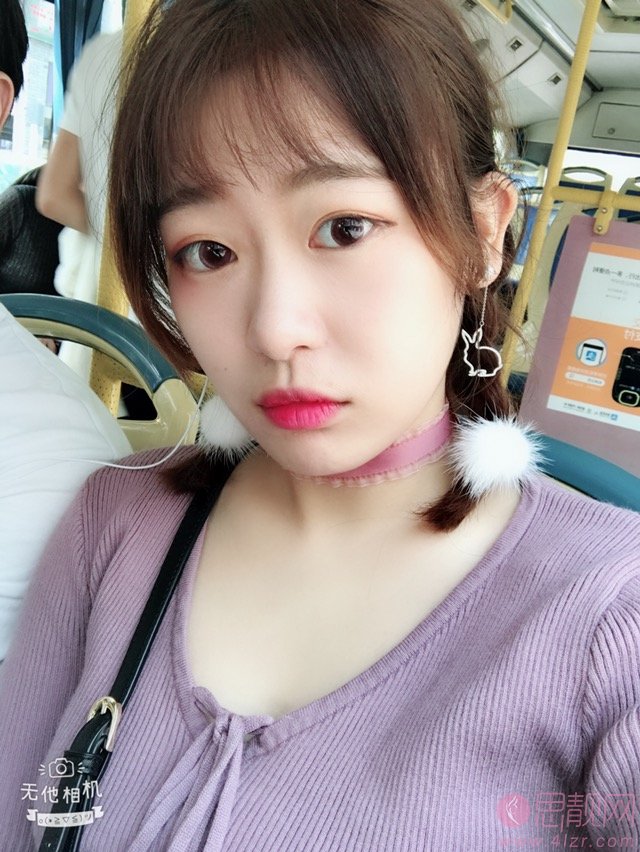 安徽医科大学第一附属医院整形美容中心做双眼皮怎么样？附双眼皮真人案例分享