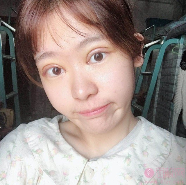 安徽医科大学第一附属医院整形美容中心做双眼皮怎么样？附双眼皮真人案例分享