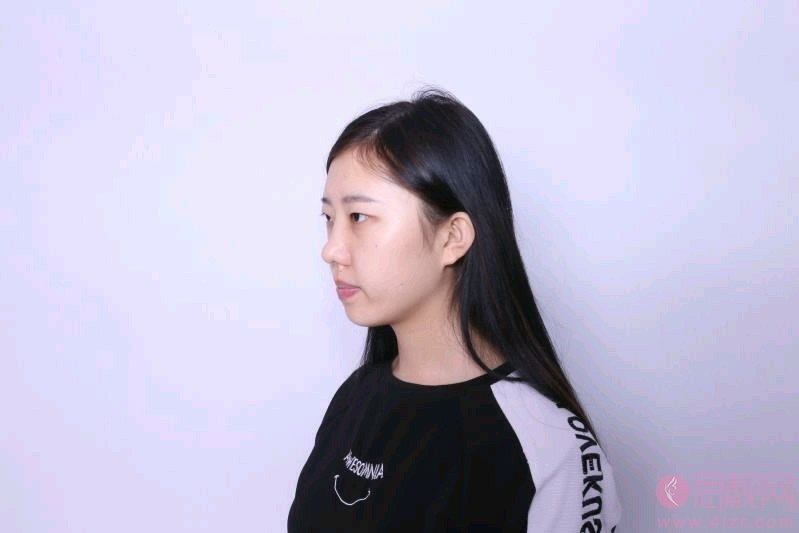 厦门欧韵医疗美容做双眼皮怎么样？2020价格表曝光+双眼皮真人分享