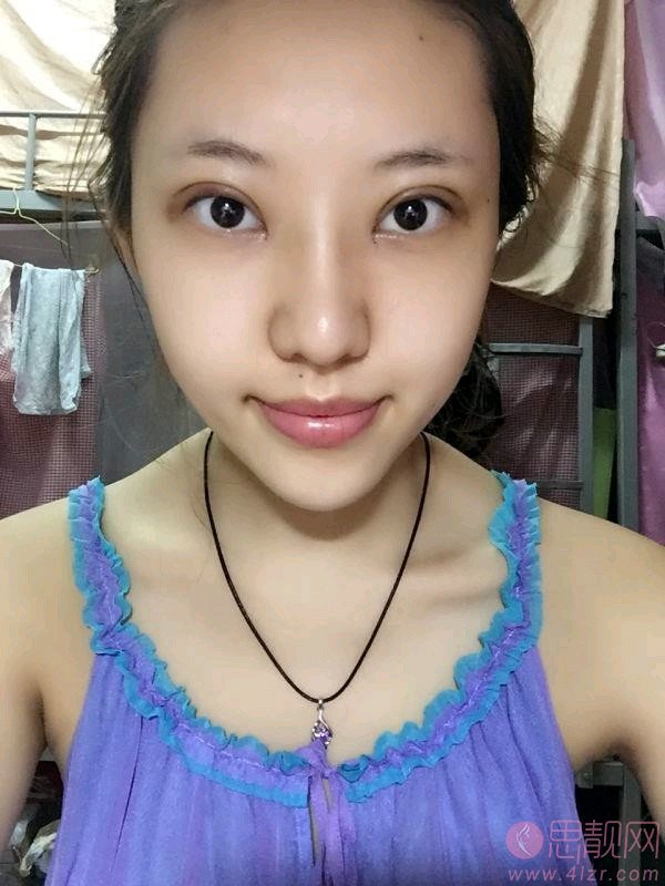 厦门欧韵医疗美容做双眼皮怎么样？2020价格表曝光+双眼皮真人分享