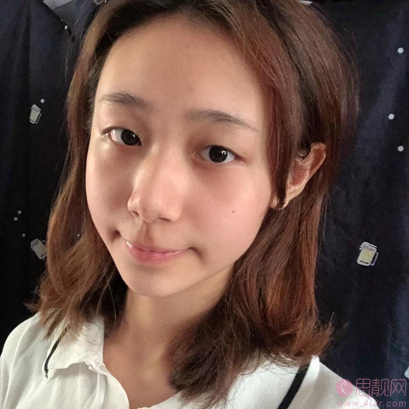 上海盈美医疗美容杨璐做下眼下至术怎么样？2020价格表曝光