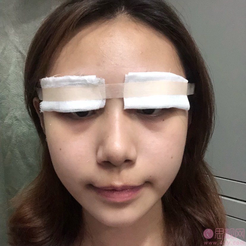上海盈美医疗美容杨璐做下眼下至术怎么样？2020价格表曝光