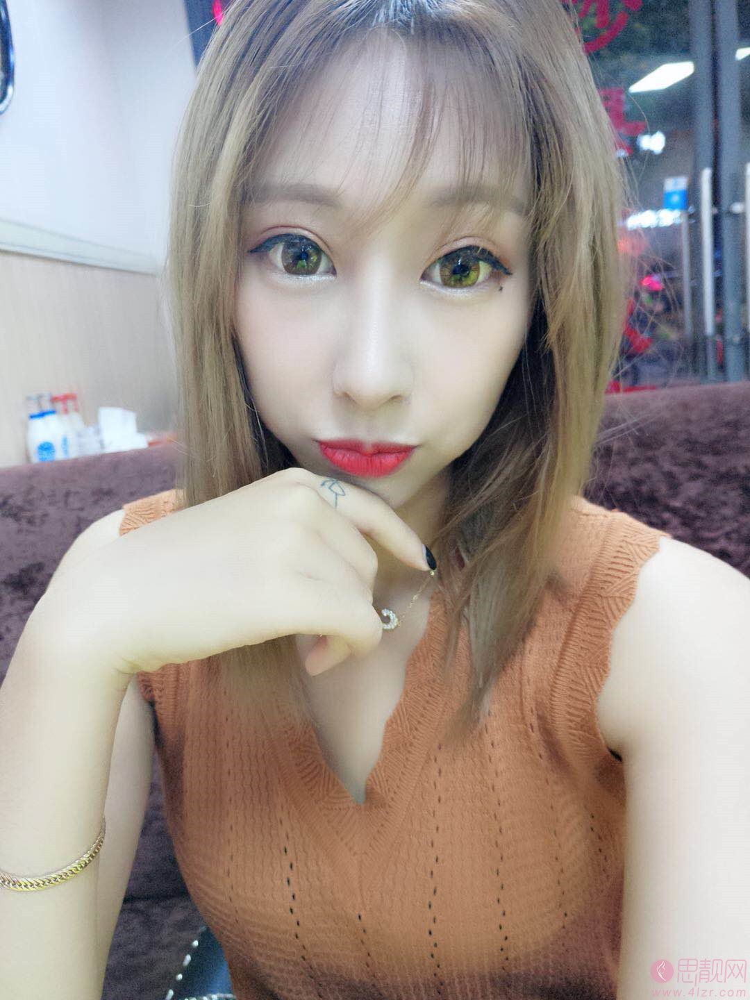 福州优医联合医美医疗美容诊所隆鼻好不好？附隆鼻真人分享案例及2020价格表一览