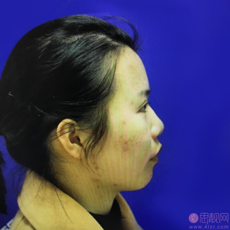 福州西美医疗美容整形隆鼻好不好？2020价格表一览+隆鼻前后真人对比效果