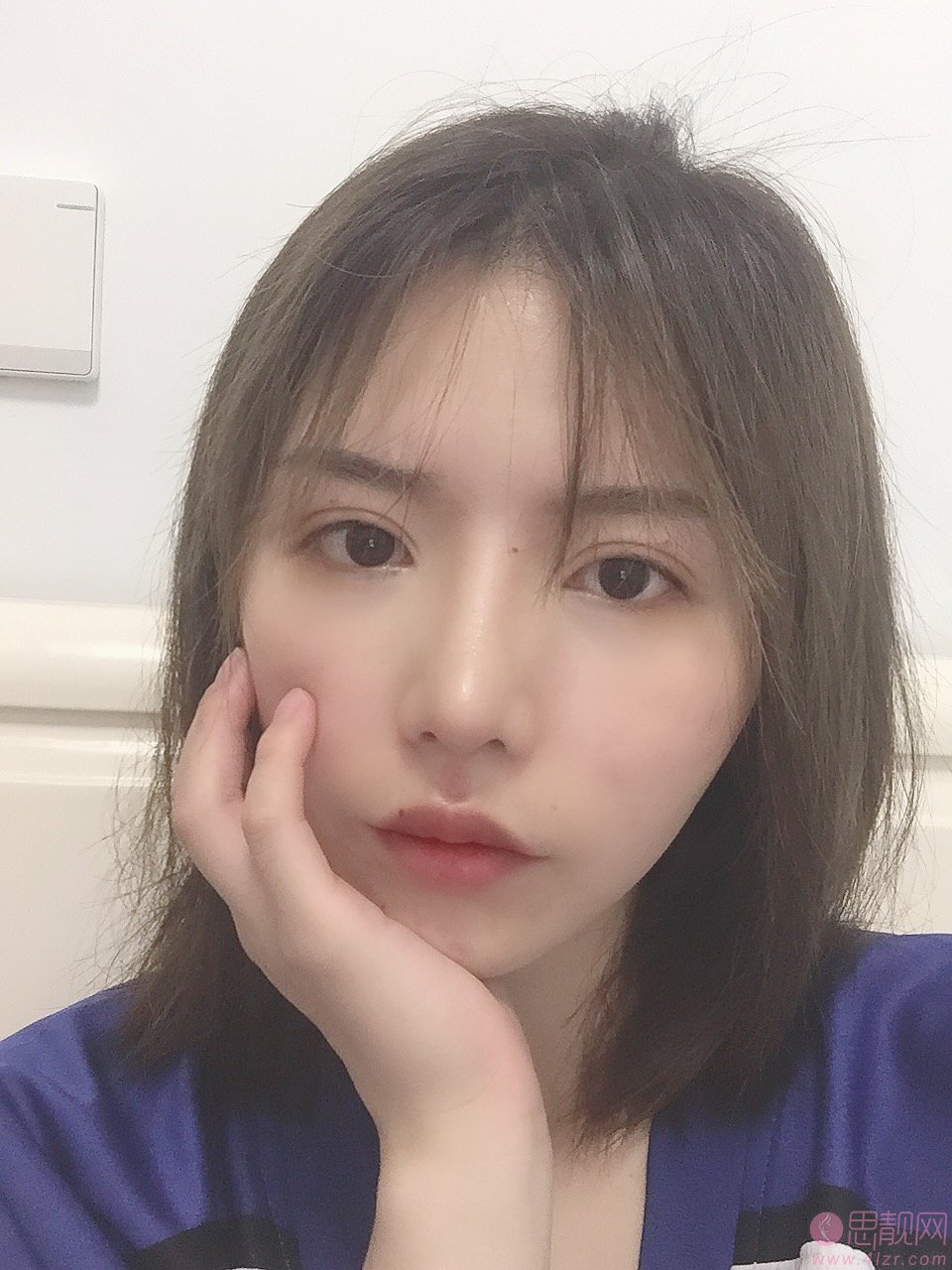 福州西美医疗美容整形隆鼻好不好？2020价格表一览+隆鼻前后真人对比效果