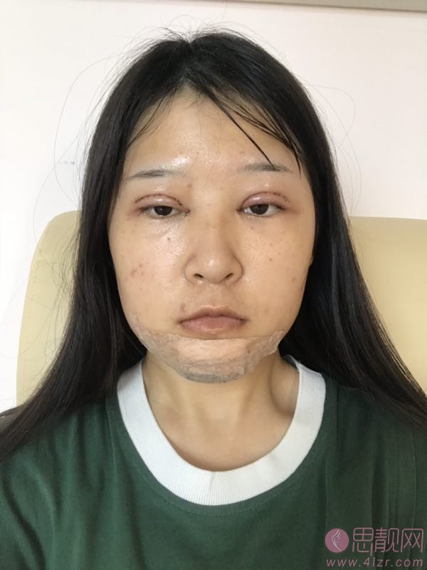 广州智媄整形医院硅胶垫下巴+双眼皮多少钱？2020价格一览+硅胶垫下巴+双眼皮术后三个月效果