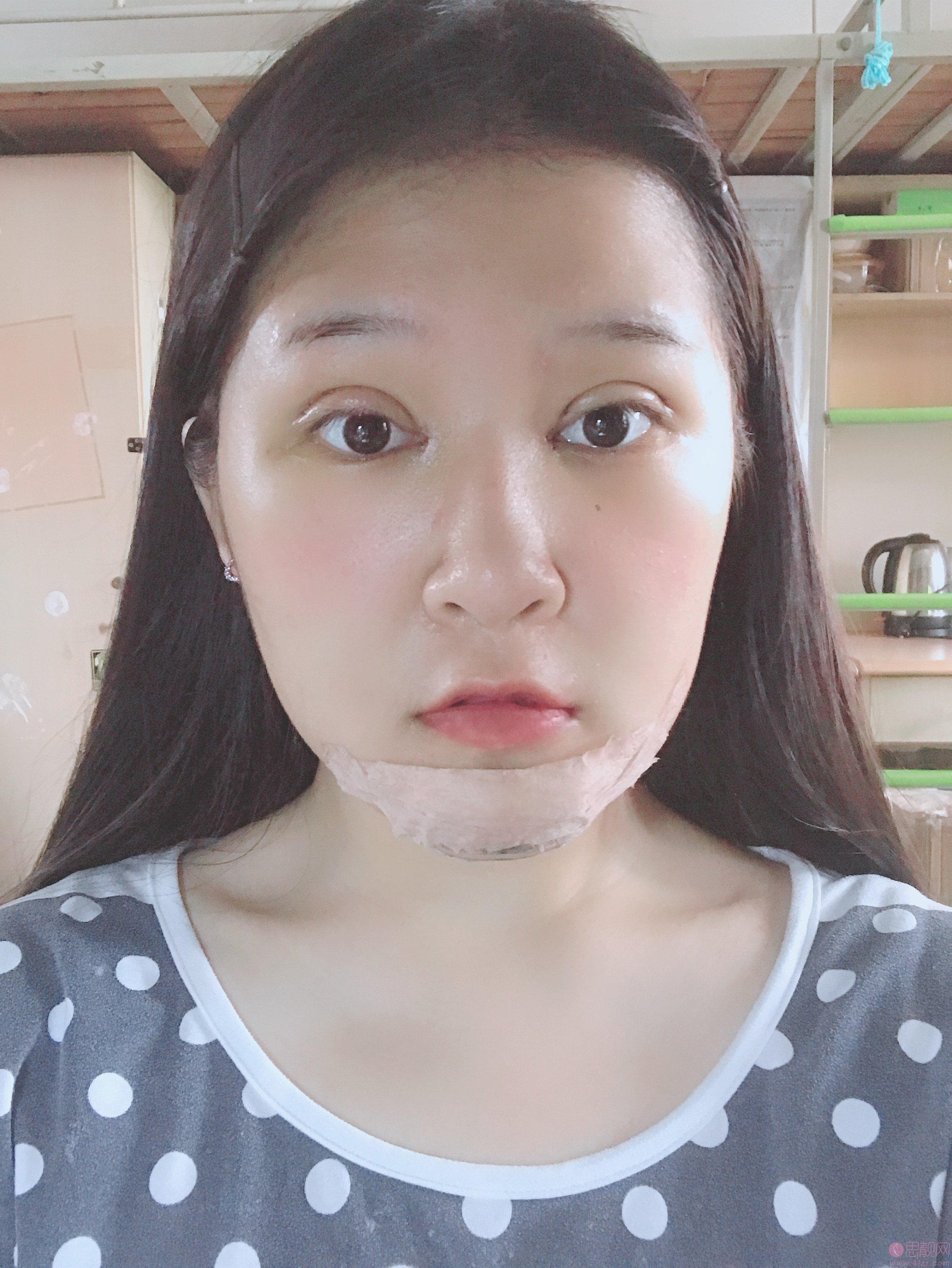 广州智媄整形医院硅胶垫下巴+双眼皮多少钱？2020价格一览+硅胶垫下巴+双眼皮术后三个月效果