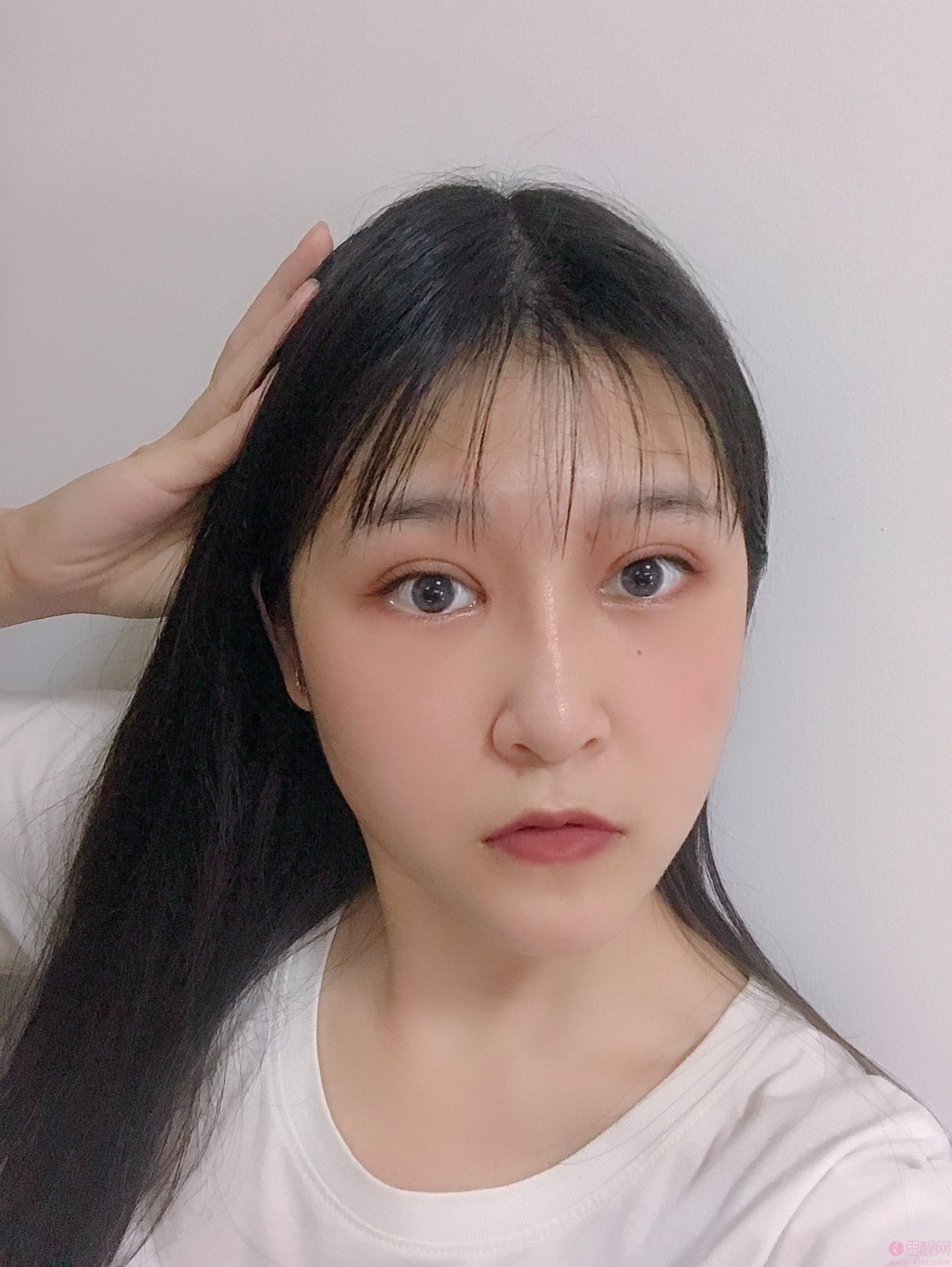 广州智媄整形医院硅胶垫下巴+双眼皮多少钱？2020价格一览+硅胶垫下巴+双眼皮术后三个月效果