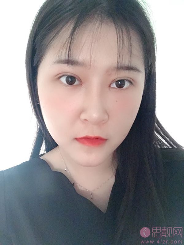 广州智媄整形医院硅胶垫下巴+双眼皮多少钱？2020价格一览+硅胶垫下巴+双眼皮术后三个月效果