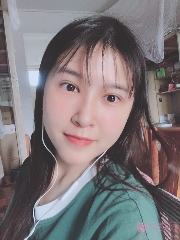 广州智媄整形医院硅胶垫下巴+双眼皮多少钱？2020价格一览+硅胶垫下巴+双眼皮术后三个月效果