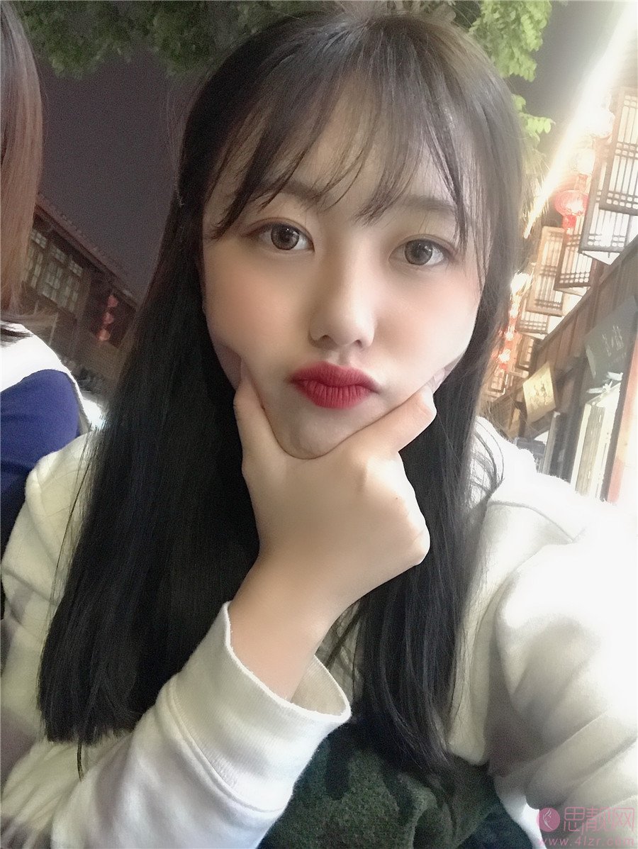 贵阳华美整形美容医院做双眼皮手术好不好？2020价格表曝光+双眼皮术后三个月效果展示