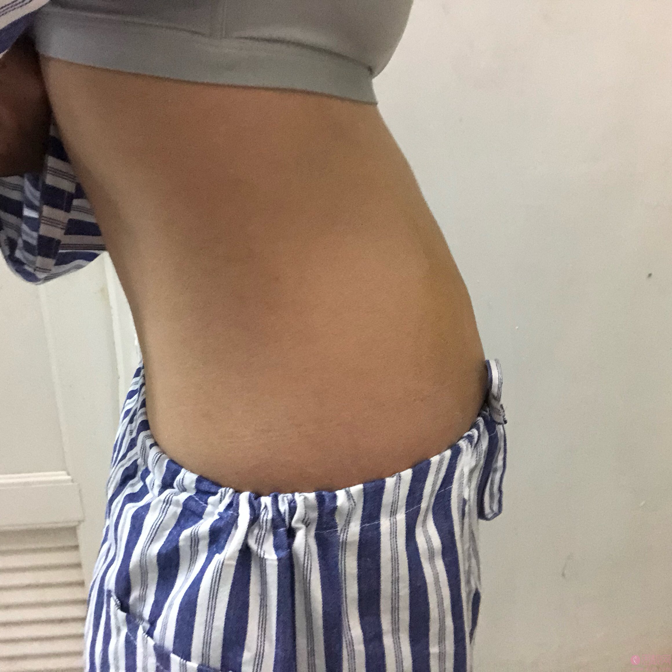 贵阳美贝尔医疗美容医院【西南旗舰院】吸脂瘦腰腹效果好不好？2020价格表曝光+吸脂瘦腰真人案例分享
