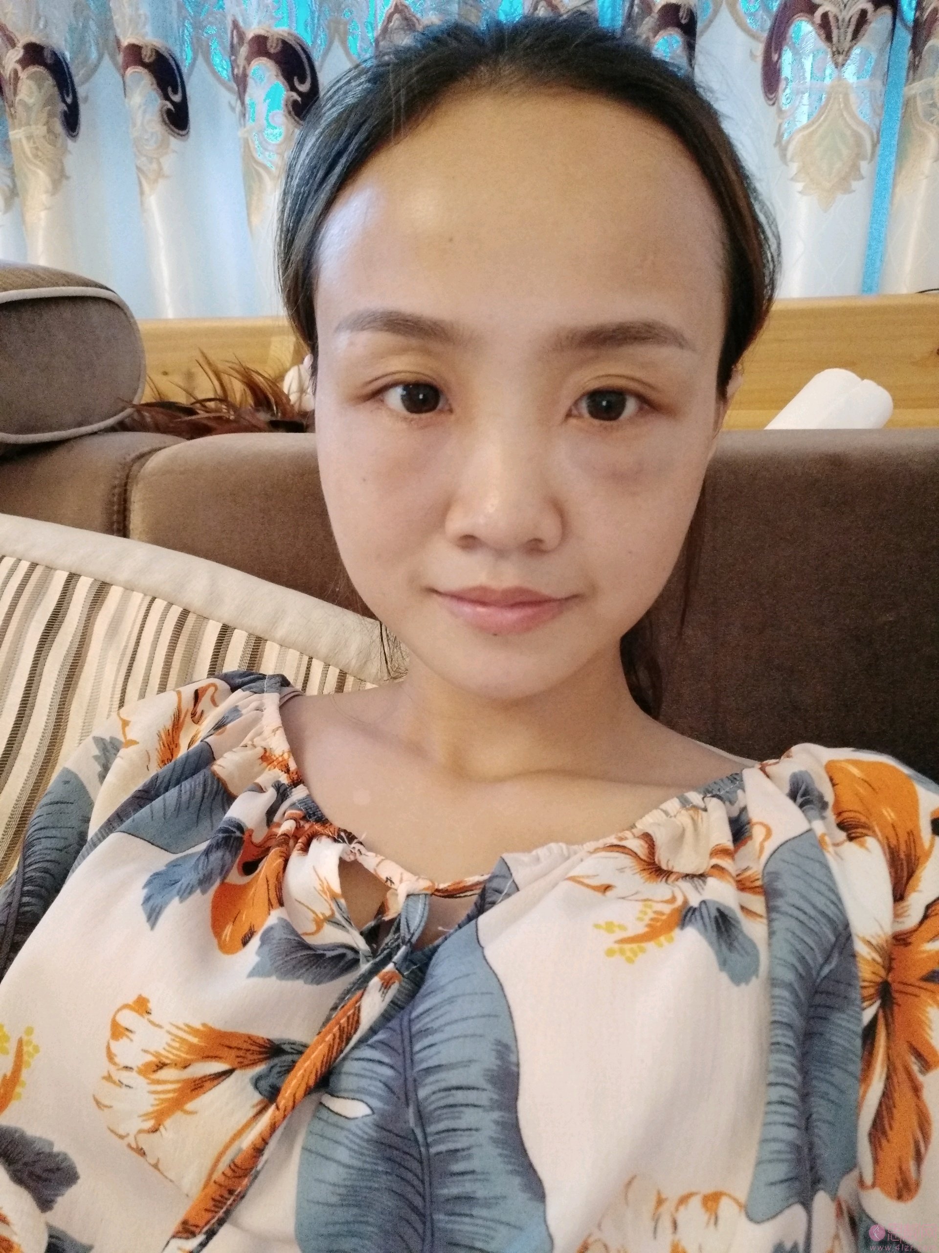 贵阳丽都医疗美容医院口碑好不好?附内切祛眼袋真人案例分享及2020价格表上线