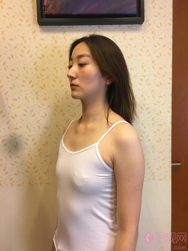 南京艺星医疗美容医院做假体隆胸怎么样？2020价格表曝光+隆胸术后二个月效果展示