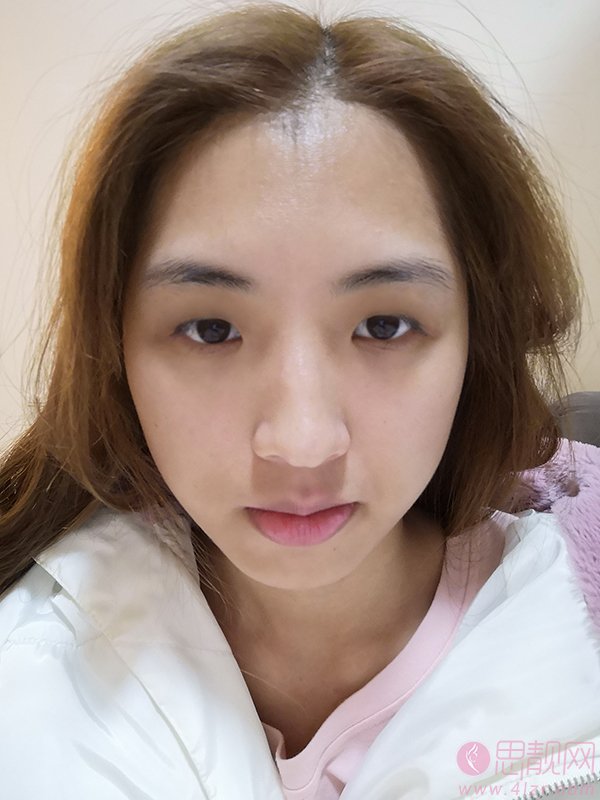 上海GK梵丽医疗美容（韩国GK分院）王屏医生做切开双眼皮怎么样？2020价格表一览+双眼皮真人术后案例反馈