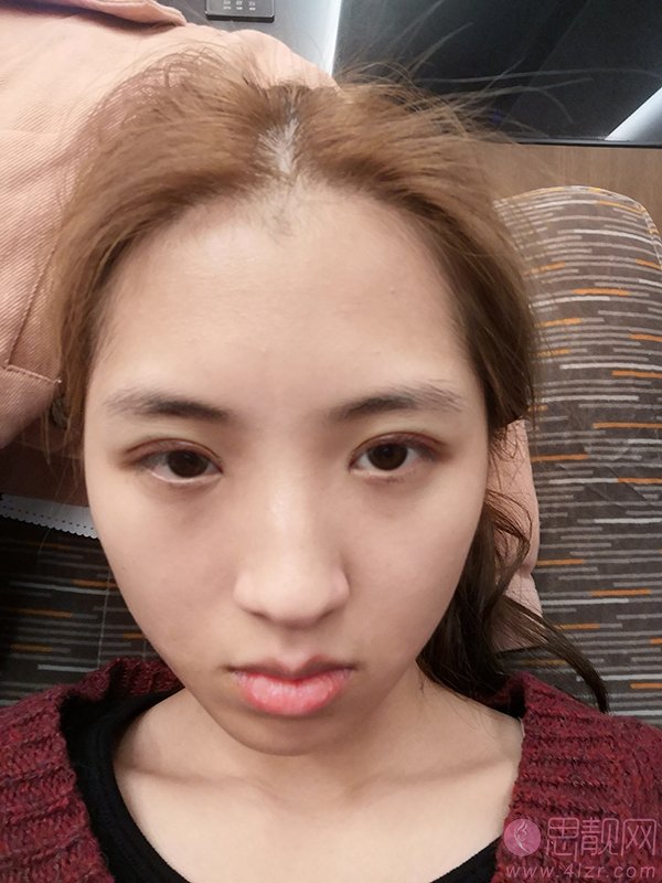 上海GK梵丽医疗美容（韩国GK分院）王屏医生做切开双眼皮怎么样？2020价格表一览+双眼皮真人术后案例反馈