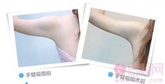 吸脂后会留疤吗？如何护理好？