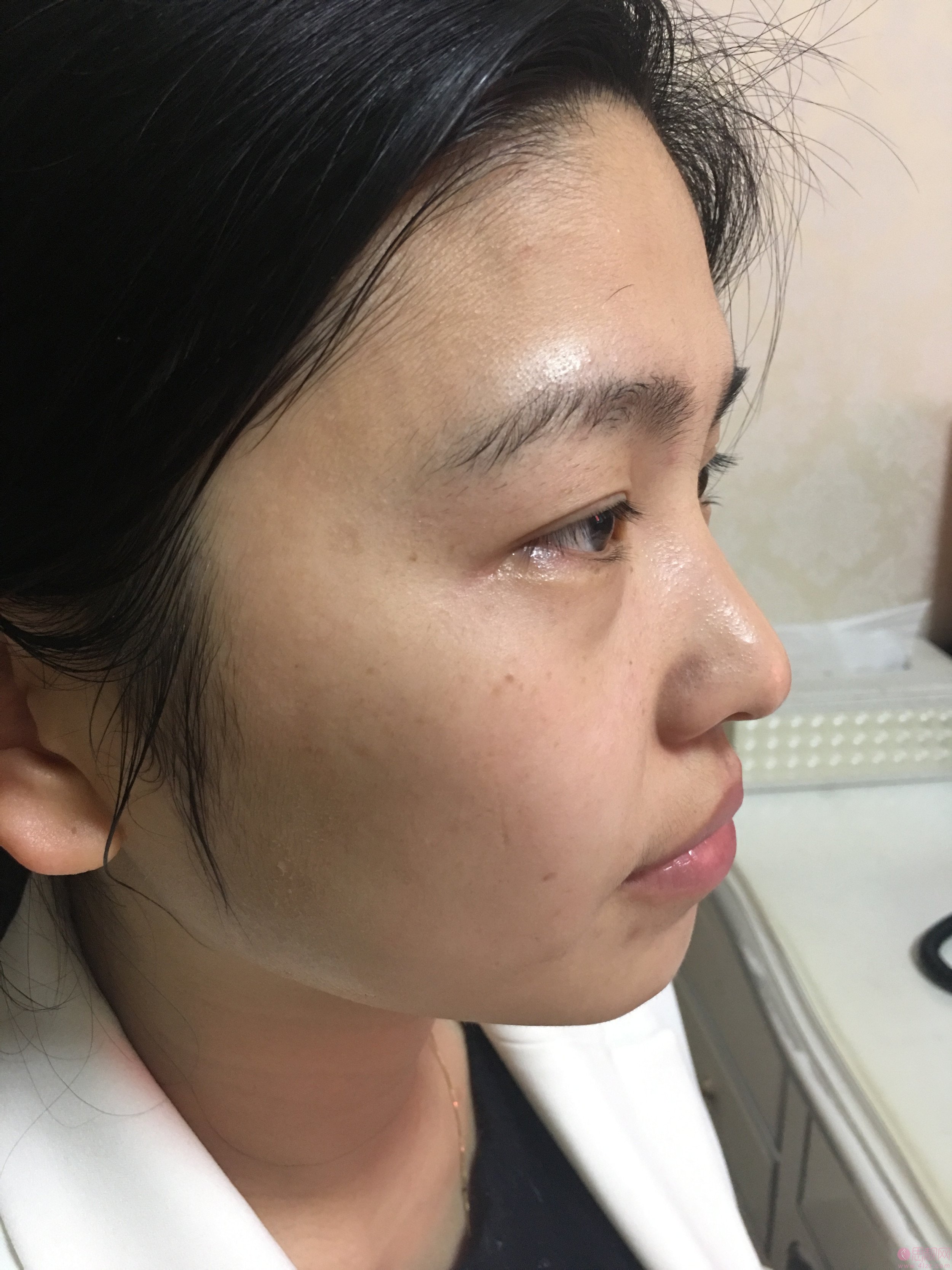 成都恒博皮肤光学祛斑怎么样？2020价格表一览+祛斑术后真人案例反馈