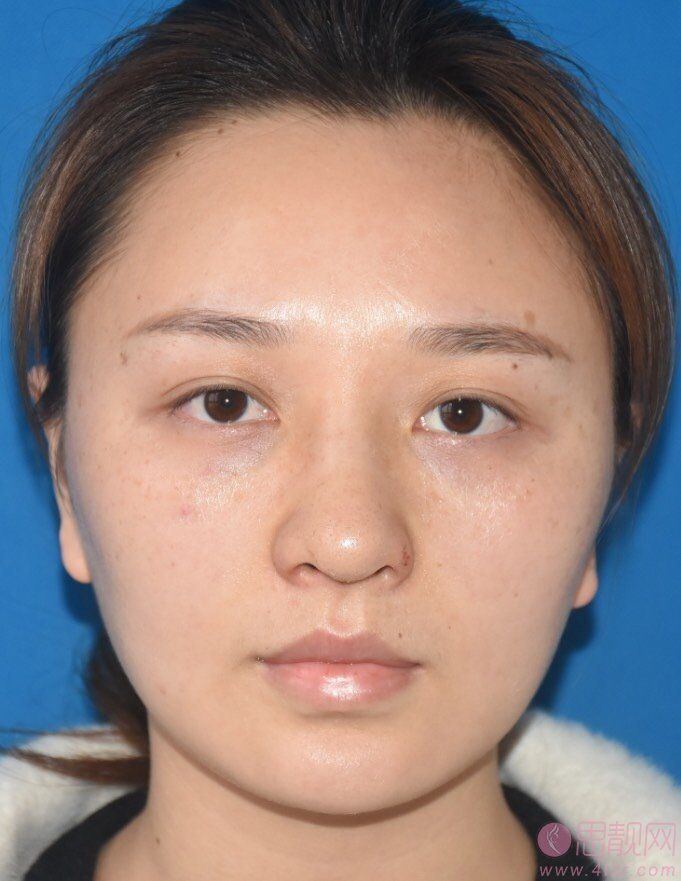 上海慕华医疗美容（原三甲医院专家团队）隆鼻怎么样？2020价格表一览+隆鼻真人案例分享