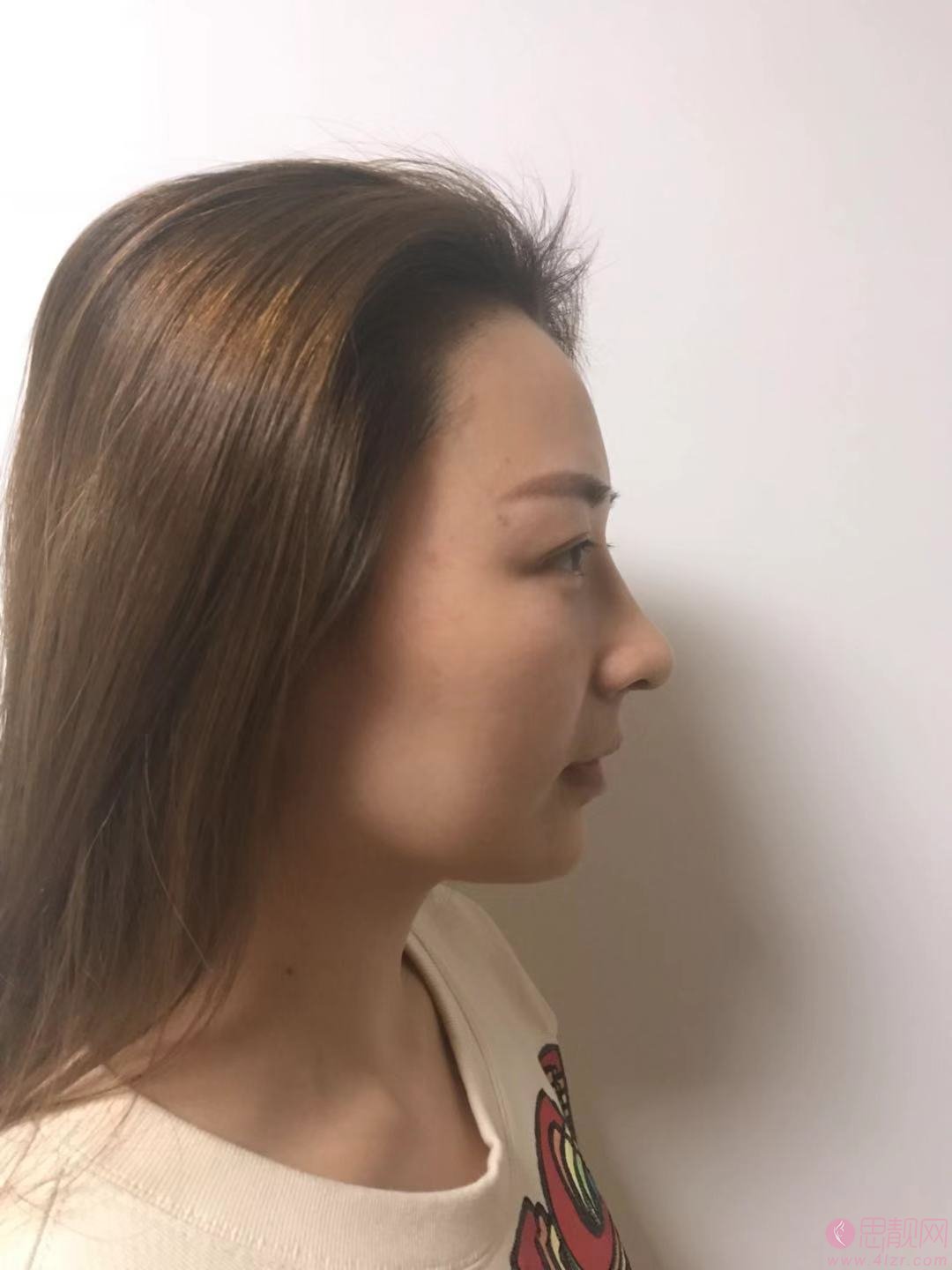 上海慕华医疗美容（原三甲医院专家团队）隆鼻怎么样？2020价格表一览+隆鼻真人案例分享