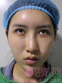 成都健丽（眼部整形连锁）张登洋医生激光去眼袋怎么样？2020价格表爆光