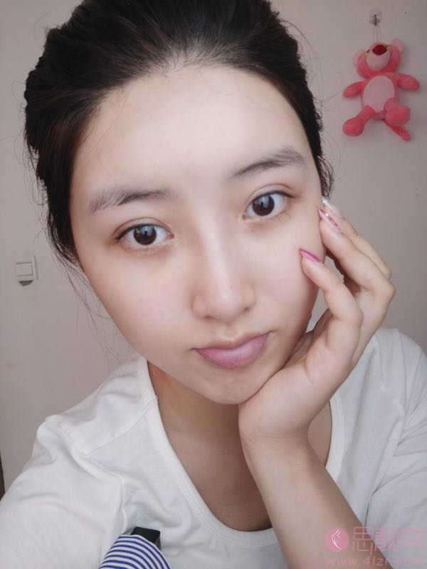 成都健丽（眼部整形连锁）张登洋医生激光去眼袋怎么样？2020价格表爆光