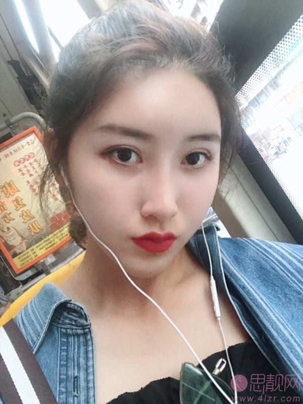 成都健丽（眼部整形连锁）张登洋医生激光去眼袋怎么样？2020价格表爆光