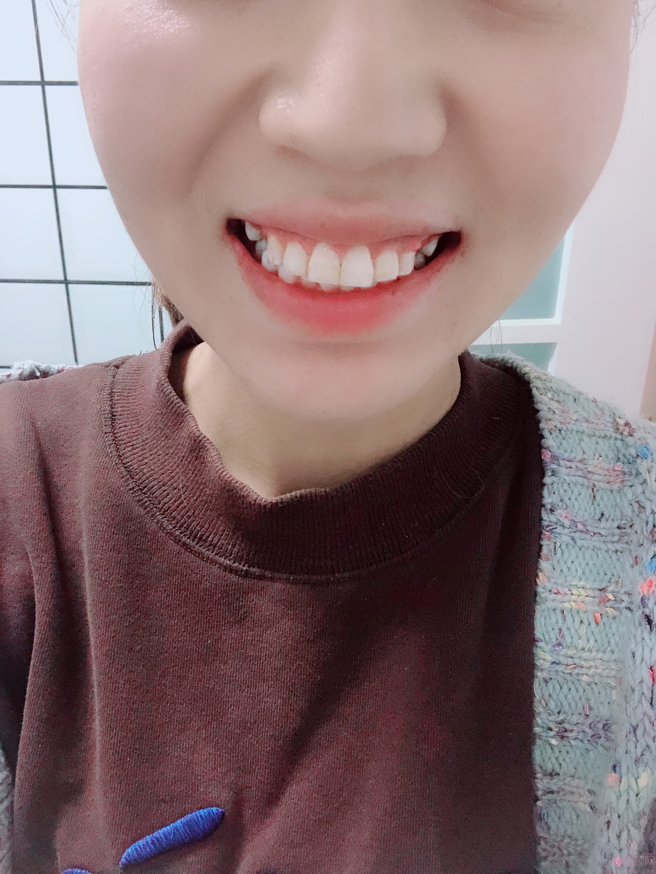 郑州美莱医疗美容医院牙齿矫正怎么样?2020价格表曝光