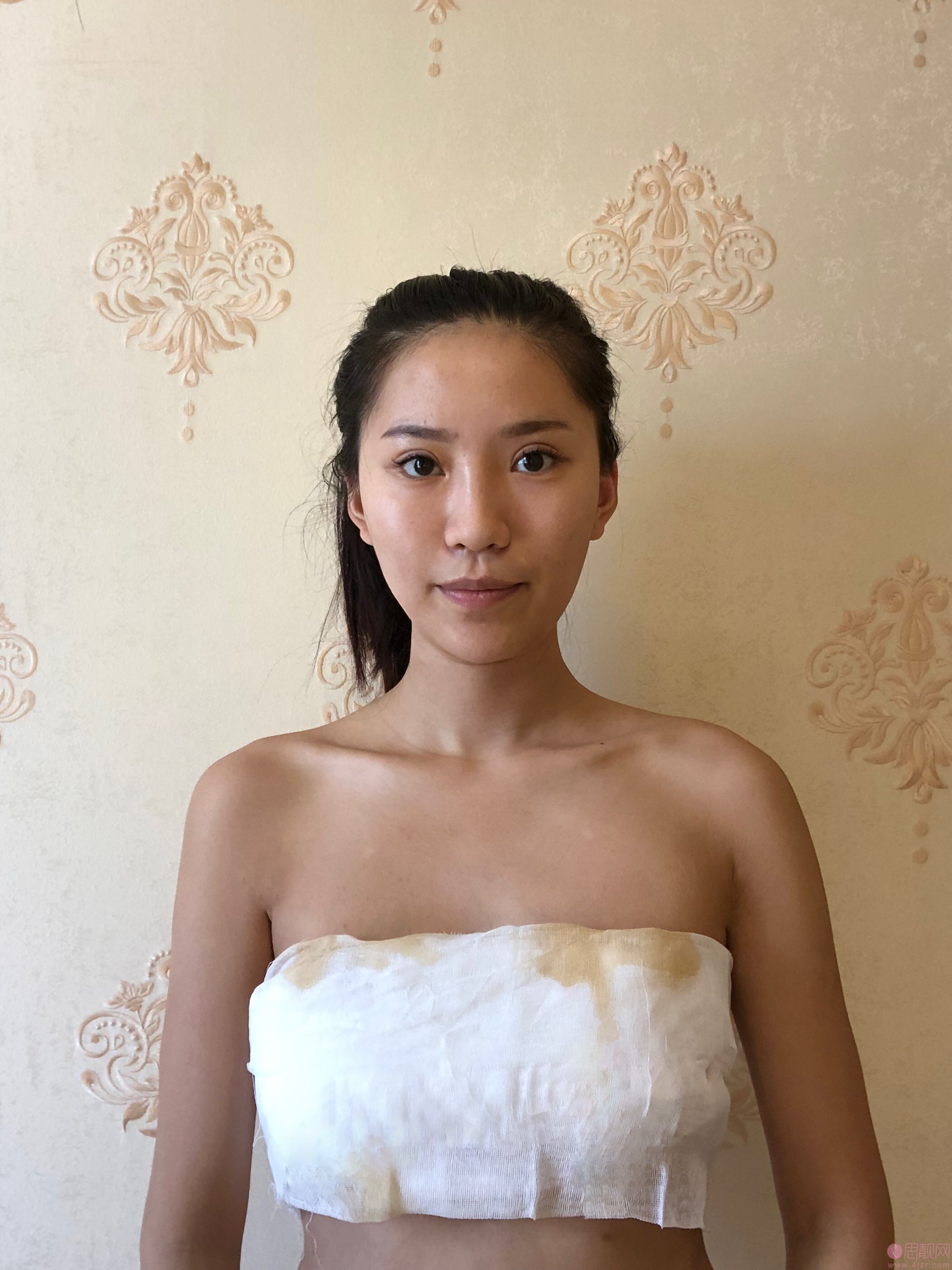 成都美上美医疗美容罗通贵医生做假体隆胸怎么样？2020价格表一览+隆胸真人案例分享